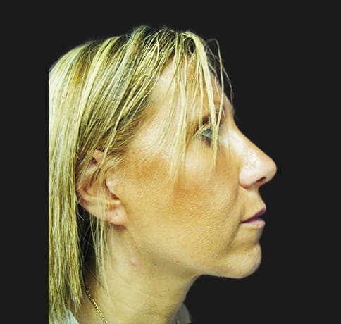 Case 2115 , Performed By Dr. Tehrani – After