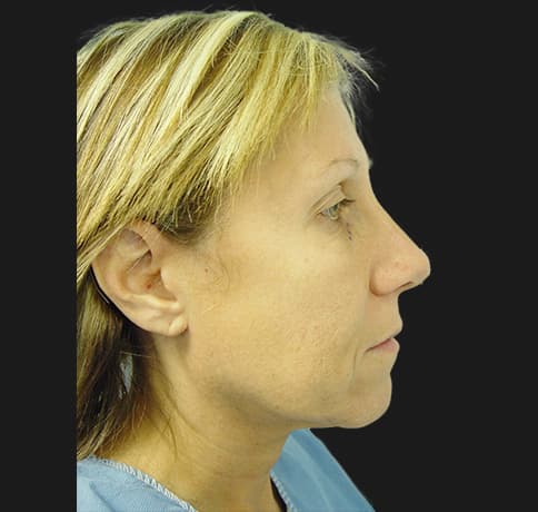 Case 2115 , Performed By Dr. Tehrani – Before