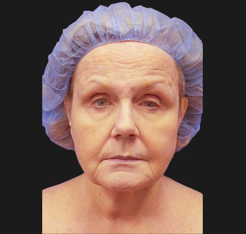 Case 41324 , Performed By Dr. Tehrani – angle 3 Before
