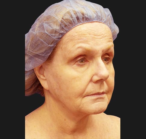 Case 41324 , Performed By Dr. Tehrani – angle 4 Before