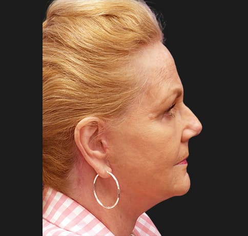 Case 41324 , Performed By Dr. Tehrani – After
