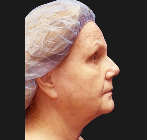 Case 41324 , Performed By Dr. Tehrani – Before