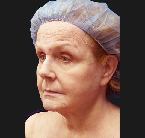 Case 41324 , Performed By Dr. Tehrani – angle 5 Before