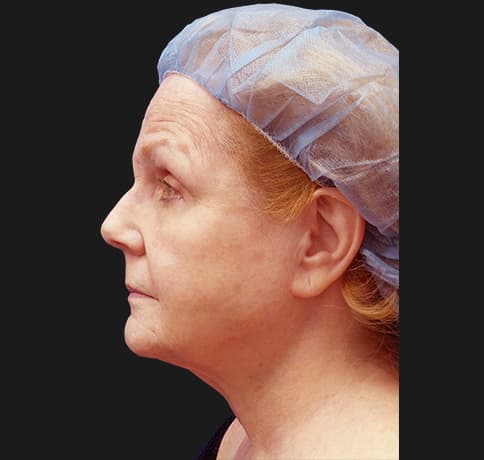 Case 41324 , Performed By Dr. Tehrani – Before