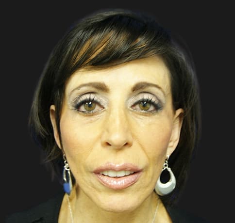 Case 8613 , Performed By Dr. Tehrani – angle 3 After