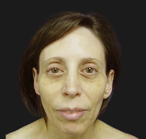 Case 8613 , Performed By Dr. Tehrani – angle 3 Before