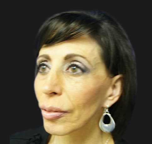 Case 8613 , Performed By Dr. Tehrani – angle 4 After