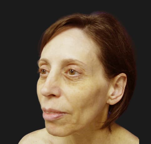 Case 8613 , Performed By Dr. Tehrani – angle 4 Before