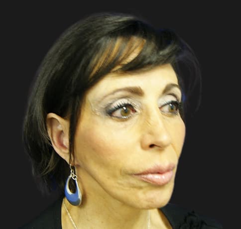 Case 8613 , Performed By Dr. Tehrani – angle 5 After