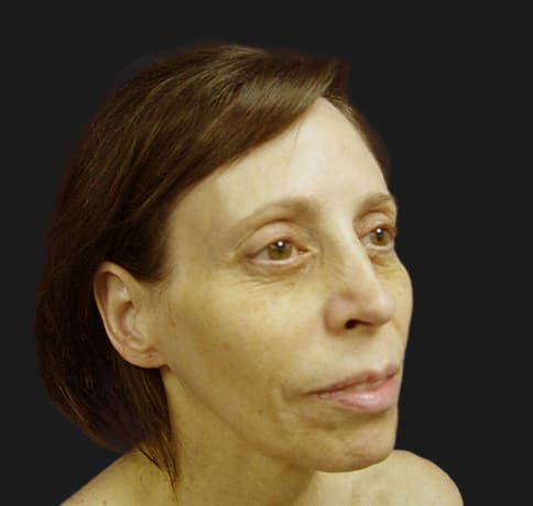 Case 8613 , Performed By Dr. Tehrani – angle 5 Before