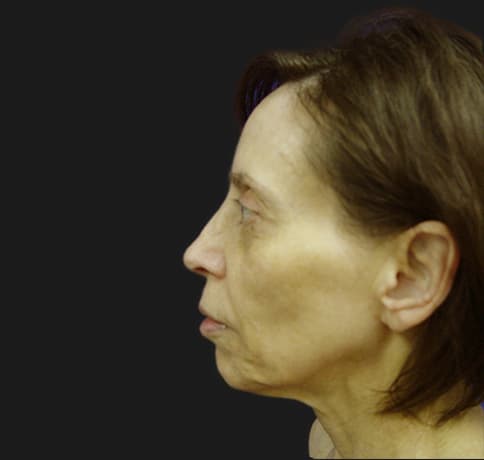 Case 8613 , Performed By Dr. Tehrani – Before