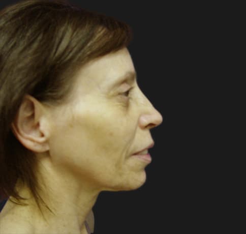 Case 8613 , Performed By Dr. Tehrani – Before