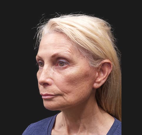 Case 42444, Performed By Dr. Tehrani – After