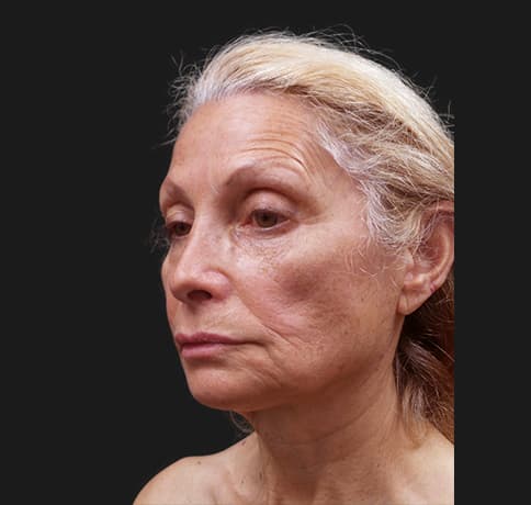Case 42444, Performed By Dr. Tehrani – Before
