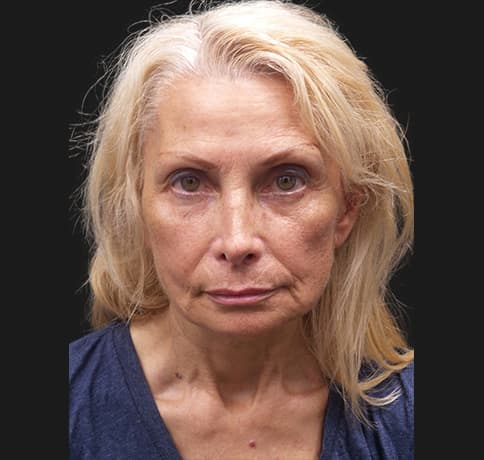 Case 42444, Performed By Dr. Tehrani – angle 3 After