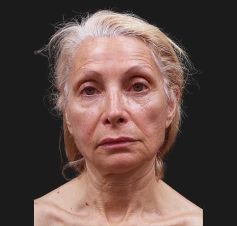 Case 42444, Performed By Dr. Tehrani – angle 3 Before