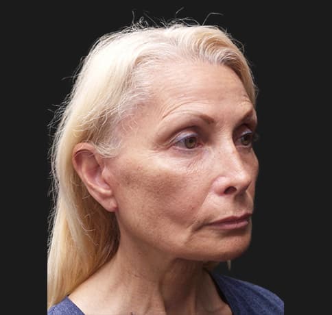 Case 42444, Performed By Dr. Tehrani – After