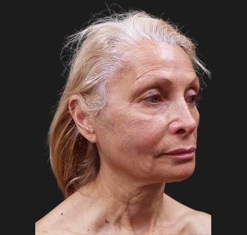 Case 42444, Performed By Dr. Tehrani – Before