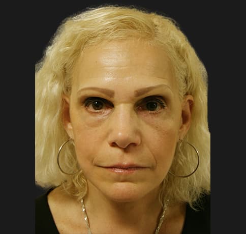 Case 12252 , Performed By Dr. Tehrani – angle 3 After