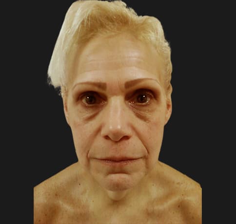 Case 12252 , Performed By Dr. Tehrani – angle 3 Before