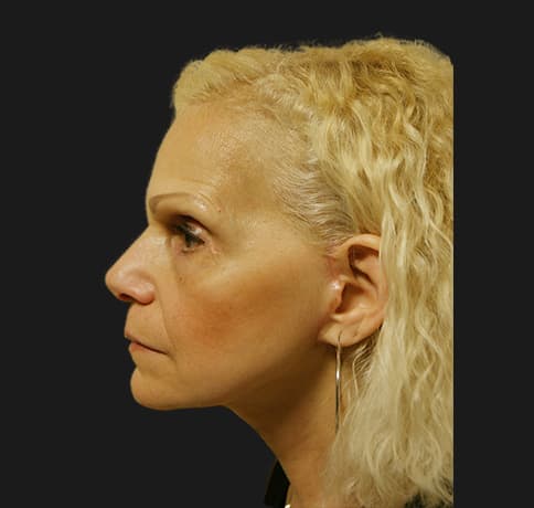 Case 12252 , Performed By Dr. Tehrani – After