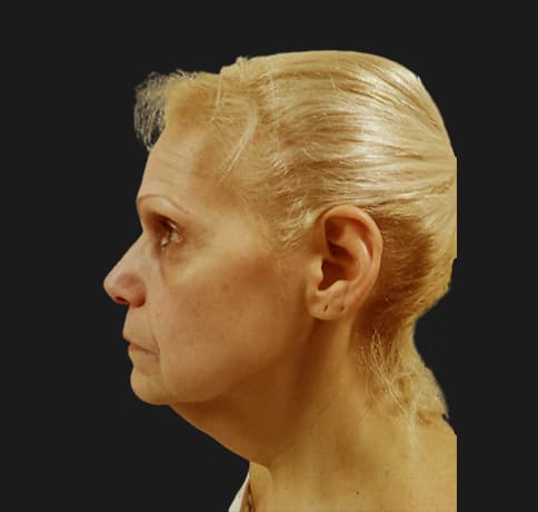 Case 12252 , Performed By Dr. Tehrani – Before