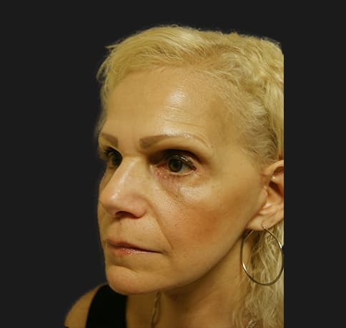 Case 12252 , Performed By Dr. Tehrani – angle 4 After