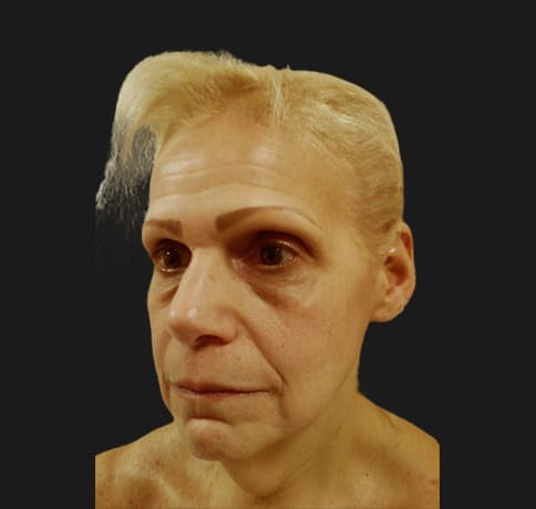 Case 12252 , Performed By Dr. Tehrani – angle 4 Before