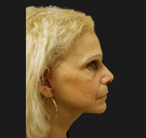 Case 12252 , Performed By Dr. Tehrani – After