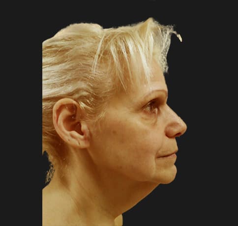 Case 12252 , Performed By Dr. Tehrani – Before
