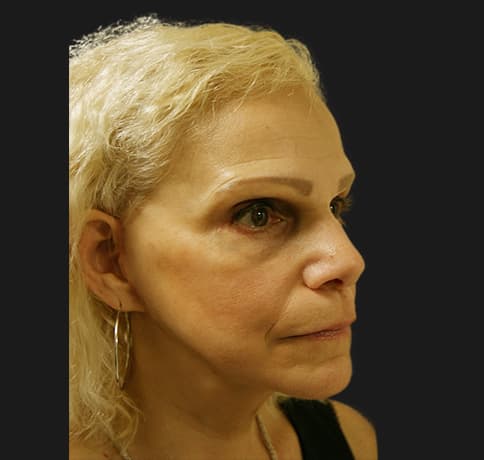 Case 12252 , Performed By Dr. Tehrani – angle 5 After