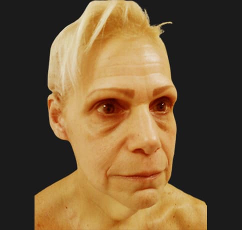 Case 12252 , Performed By Dr. Tehrani – angle 5 Before
