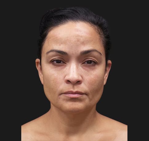 Case 52263, Performed By Dr. Tehrani – Before