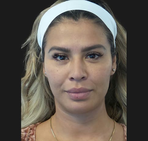 Case 53163, Performed By Dr. Tehrani – Before