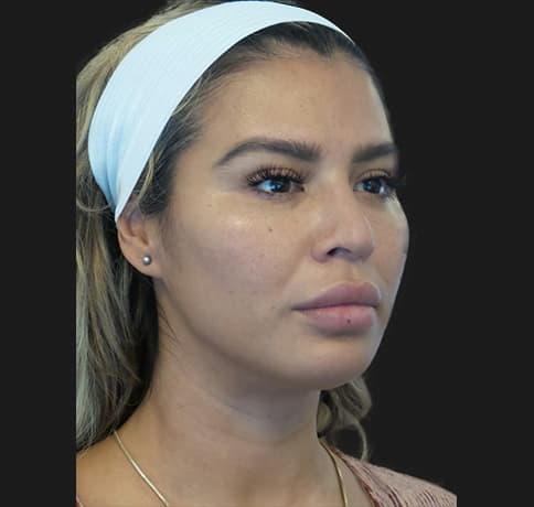 Case 53163, Performed By Dr. Tehrani – angle 3 Before