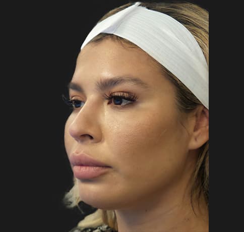 Case 53163, Performed By Dr. Tehrani – angle 4 After