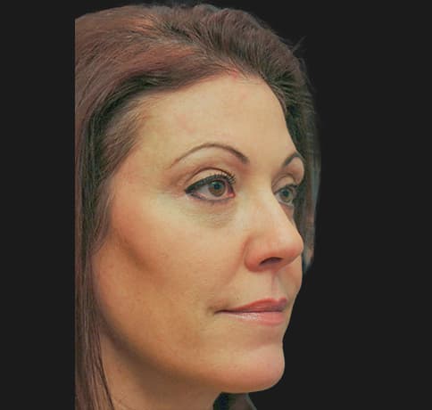 Case 3918 , Performed By Dr. Tehrani – After