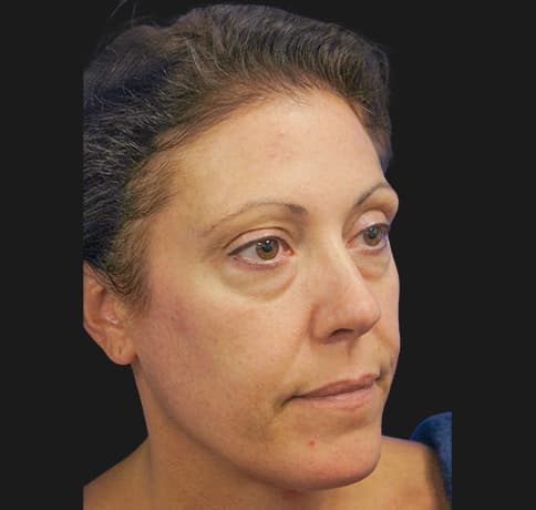 Case 3918 , Performed By Dr. Tehrani – Before