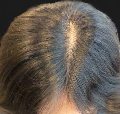 Case 314, Performed By Dr. Tehrani – Before