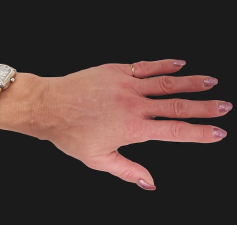 Case 9966 , Performed By Dr. Tehrani – After