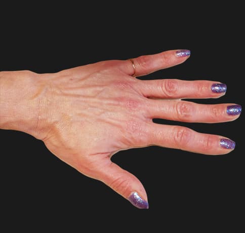 Case 9966 , Performed By Dr. Tehrani – Before