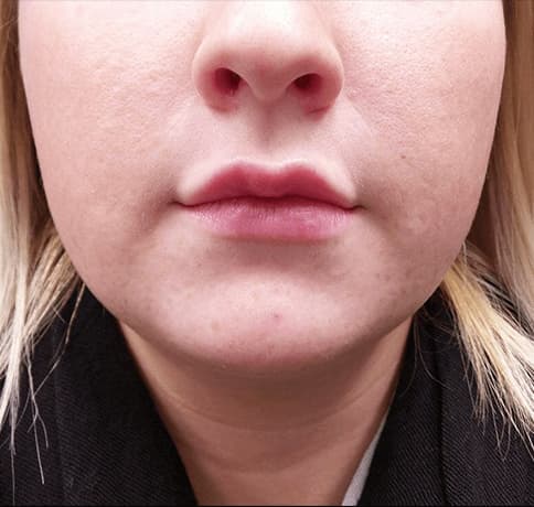 Case 33291, Performed By Dr. Tehrani – After