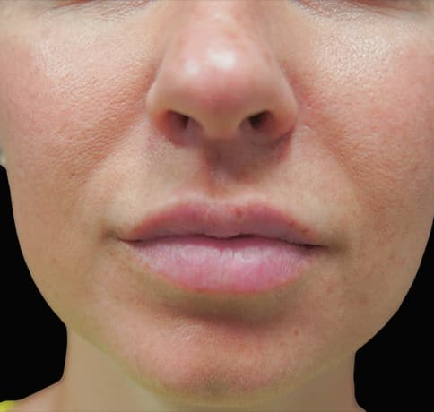 Case 29861 , Performed By Dr. Tehrani – After