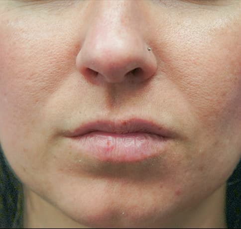 Case 29861 , Performed By Dr. Tehrani – Before