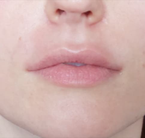 Case 200, Performed By Dr. Tehrani – After