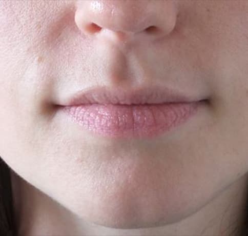 Case 200, Performed By Dr. Tehrani – Before
