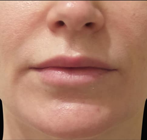 Case 38119 , Performed By Dr. Tehrani – After