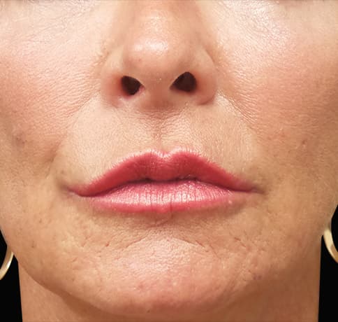 Case 36853, Performed By Dr. Tehrani – After