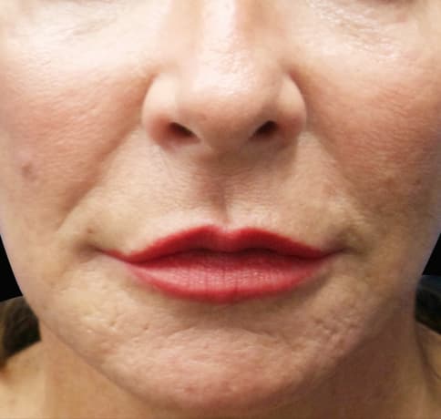 Case 36853, Performed By Dr. Tehrani – Before