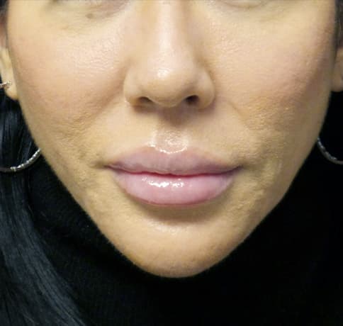 Case 44767, Performed By Dr. Tehrani – After